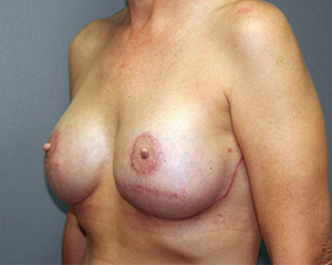 Implant Based Reconstruction Before and After Pictures Nashville, TN