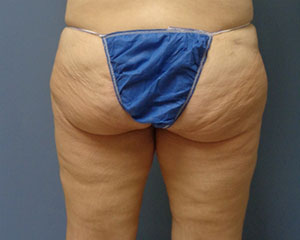 Butt Augmentation Before and After Pictures Nashville, TN