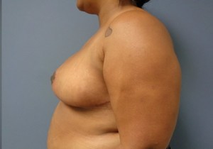 Breast Reduction Before and After Pictures Nashville, TN