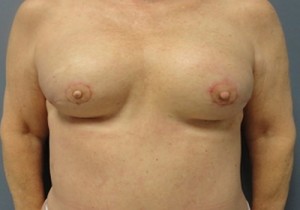 Implant Based Reconstruction Before and After Pictures Nashville, TN