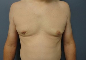 Gynecomastia Before and After Pictures Nashville, TN