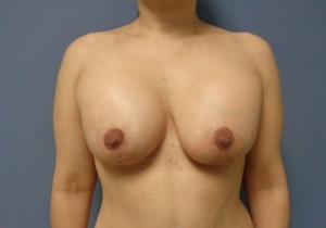 Breast Augmentation with Lift Before and After Pictures Nashville, TN