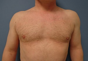 Gynecomastia Before and After Pictures Nashville, TN