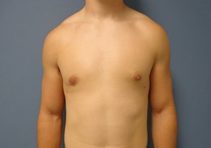 Gynecomastia Before and After Pictures Nashville, TN