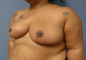 Breast Reduction Before and After Pictures Nashville, TN