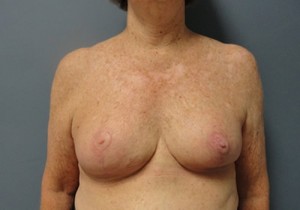 Breast Reduction Before and After Pictures Nashville, TN