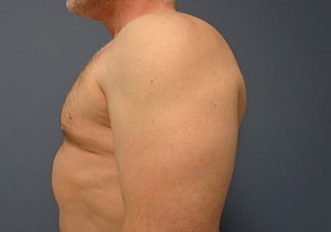 Gynecomastia Before and After Pictures Nashville, TN