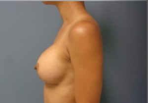 Breast Augmentation Before and After Pictures Nashville, TN