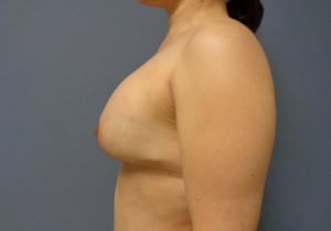 Breast Augmentation with Lift Before and After Pictures Nashville, TN