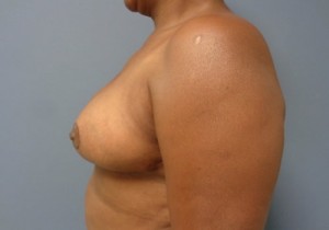 Breast Reduction Before and After Pictures Nashville, TN