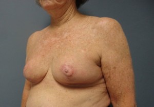 Breast Reduction Before and After Pictures Nashville, TN