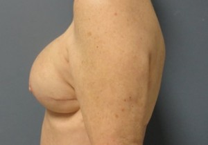 Implant Based Reconstruction Before and After Pictures Nashville, TN