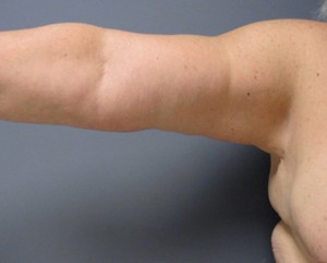 Arm Lift Before and After Pictures Nashville, TN