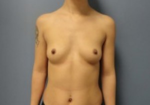 Breast Augmentation Before and After Pictures Nashville, TN