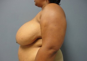 Breast Reduction Before and After Pictures Nashville, TN