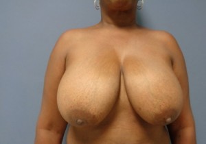 Breast Reduction Before and After Pictures Nashville, TN