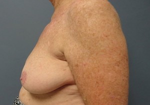 Breast Reduction Before and After Pictures Nashville, TN
