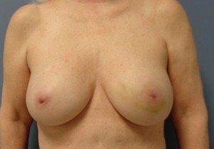 Implant Based Reconstruction Before and After Pictures Nashville, TN