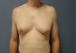 Gynecomastia Before and After Pictures Nashville, TN