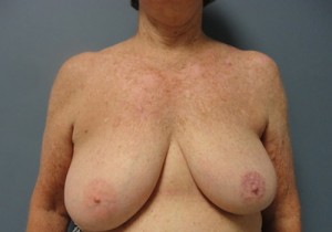 Breast Reduction Before and After Pictures Nashville, TN