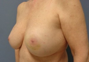 Implant Based Reconstruction Before and After Pictures Nashville, TN