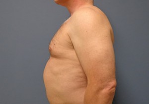 Gynecomastia Before and After Pictures Nashville, TN