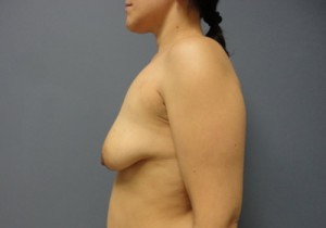 Breast Augmentation with Lift Before and After Pictures Nashville, TN