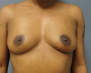 Breast Augmentation Before and After Pictures Nashville, TN