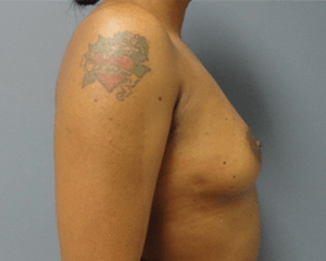 Breast Augmentation Before and After Pictures Nashville, TN