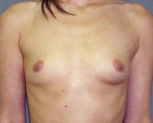 Breast Augmentation Before and After Pictures Nashville, TN