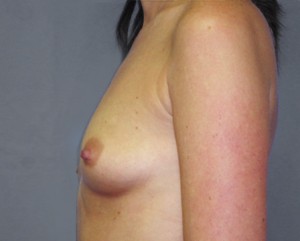 Breast Augmentation Before and After Pictures Nashville, TN