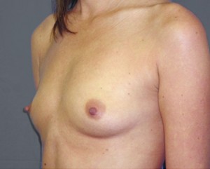 Breast Augmentation Before and After Pictures Nashville, TN