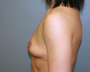 Breast Augmentation Before and After Pictures Nashville, TN
