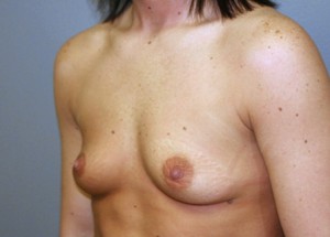 Breast Augmentation Before and After Pictures Nashville, TN