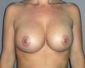 Breast Augmentation Before and After Pictures Nashville, TN
