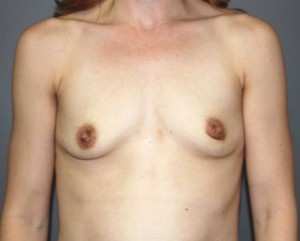 Breast Augmentation Before and After Pictures Nashville, TN