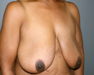 Breast Augmentation with Lift Before and After Pictures Nashville, TN