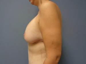 Breast Augmentation with Lift Before and After Pictures Nashville, TN