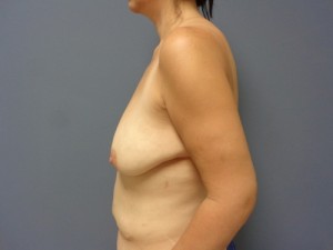 Breast Augmentation with Lift Before and After Pictures Nashville, TN