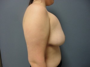 Capsular Contracture Reconstruction Before and After Pictures Nashville, TN