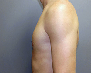 Gynecomastia Before and After Pictures Nashville, TN
