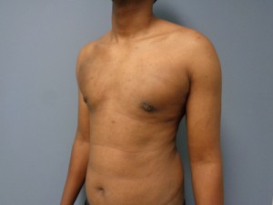 Gynecomastia Before and After Pictures Nashville, TN