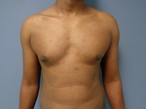 Gynecomastia Before and After Pictures Nashville, TN