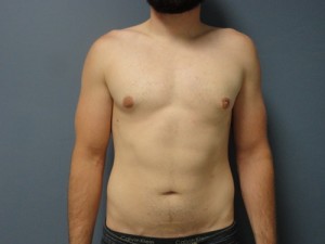 Gynecomastia Before and After Pictures Nashville, TN