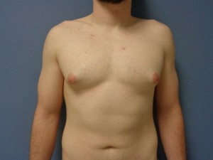 Gynecomastia Before and After Pictures Nashville, TN