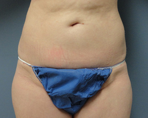 Liposuction Before and After Pictures Nashville, TN