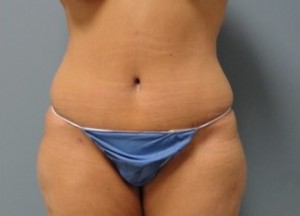 Tummy Tuck Before and After Pictures Nashville, TN