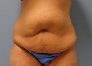 Tummy Tuck Before and After Pictures Nashville, TN