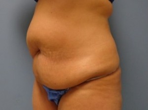 Tummy Tuck Before and After Pictures Nashville, TN