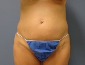 Tummy Tuck Before and After Pictures Nashville, TN